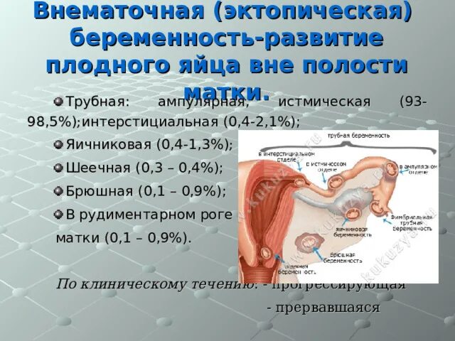 Забеременела без труб естественным путем. Истмическая беременность. Формы эктопической беременности. Ампулярная внематочная беременность. Внематочная (эктопическая) беременность.