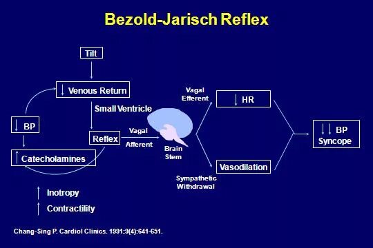 Рефлекс Bezold-Jarisch. Reflex Syncope. Рефлекс Бецольда Яриша. Bezold-Jarisch синдром.