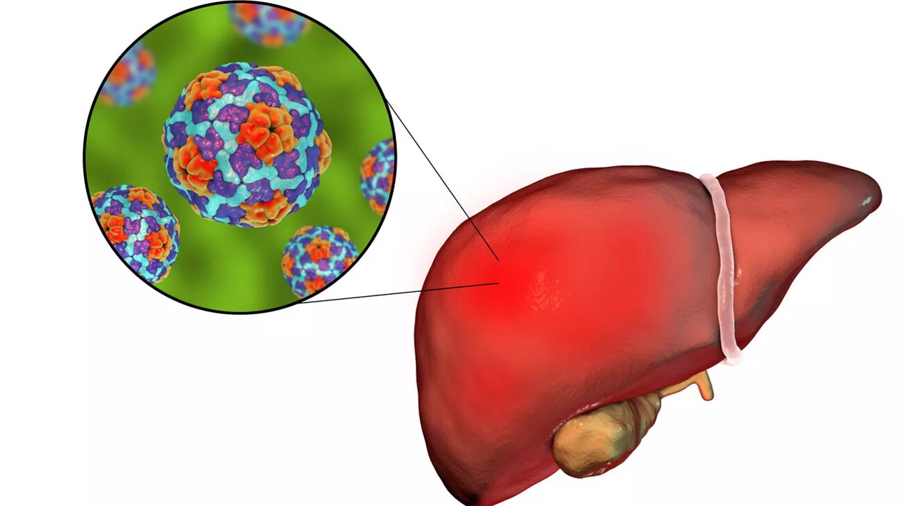 Вирусный гепатит печени. Вирусный гепатит печень. Инфекционное поражение печени. Вирусное поражение печени.