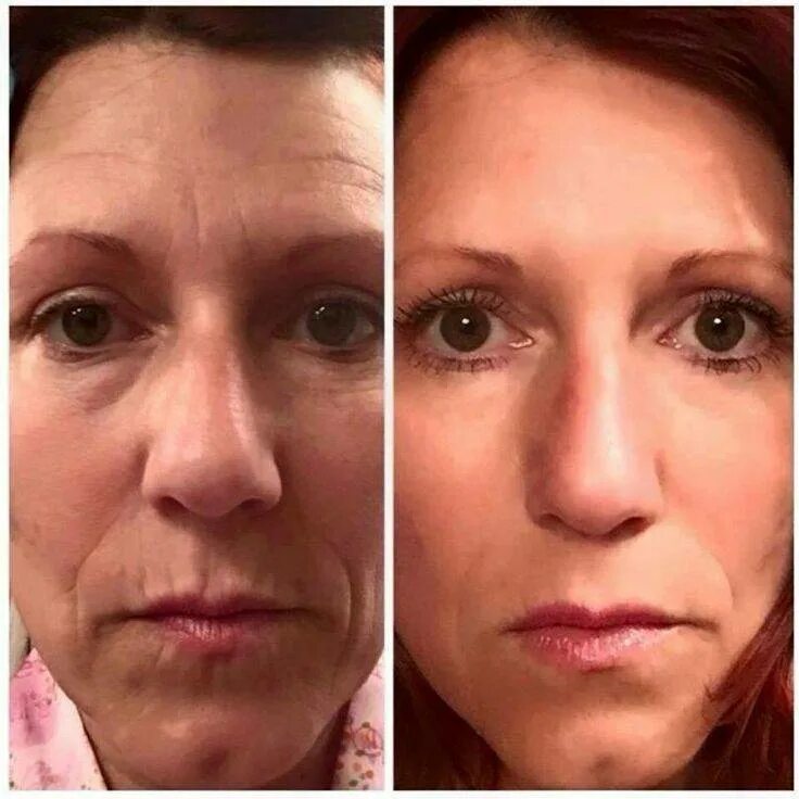 Фотоомоложение лица. Лучшее омоложение. Косметологические процедуры для лица после 30. Массаж лица картинки. Пилинг.