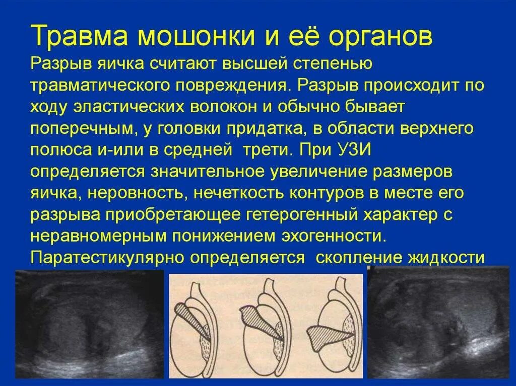 Как выглядит рак мошонки Опухоль яичка Мой уролог