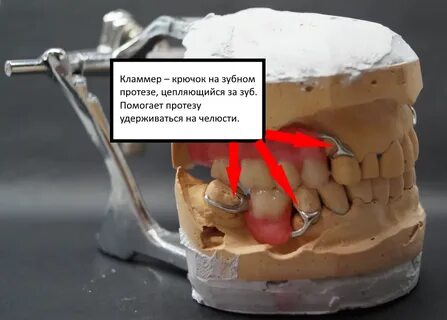 Цельнолитой каркас бюгельного протеза