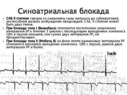 Са блокада тип 1 1 степень