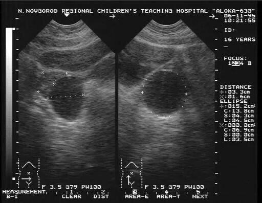 Образование округлое в яичнике. Параовариальная киста яичника. Параовариальная киста на УЗИ. Объемные образования яичников на УЗИ. Образование яичника на УЗИ.