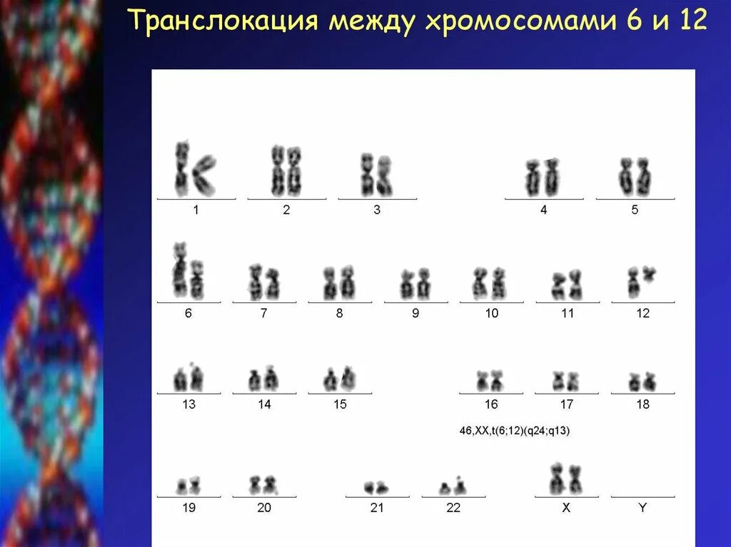 Кариотип транслокации. Робертсоновская транслокация хромосом. реципрокная транслокация кариотип. сбалансированная робертсоновская транслокация. хромосомные транслокации.
