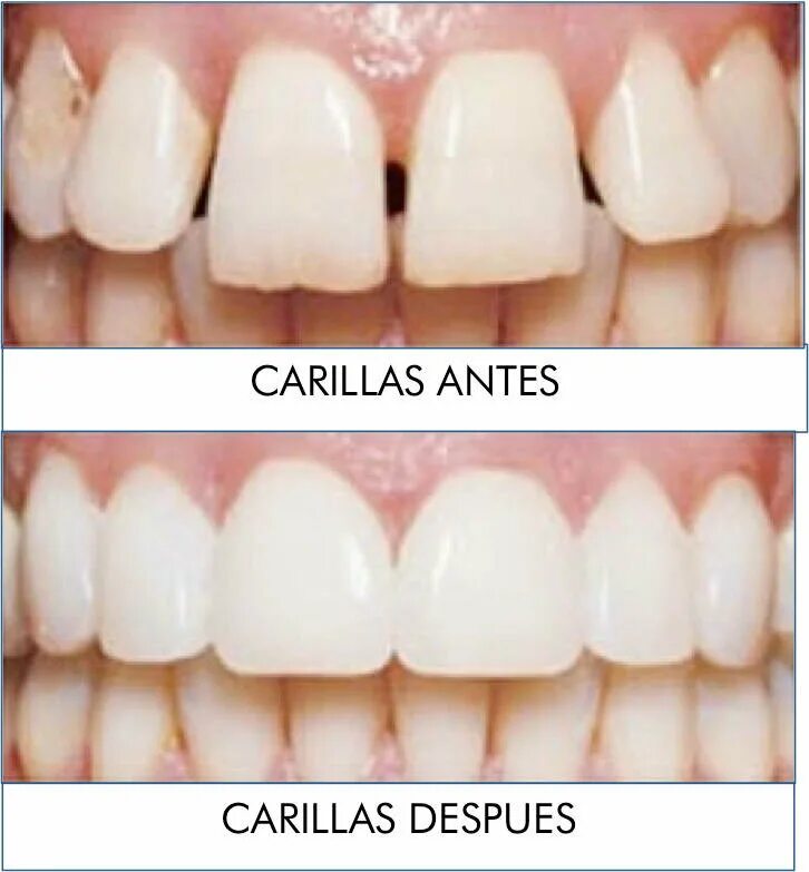 верхний зубной ряд форма