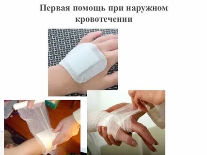 При наружном кровотечении необходимо