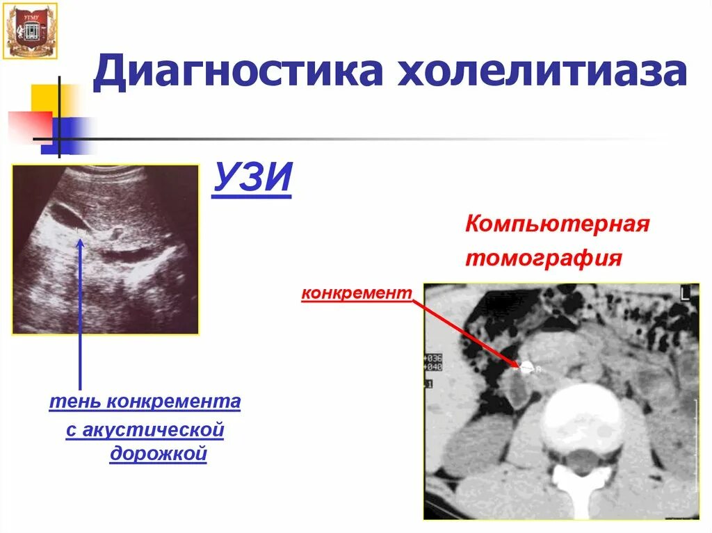 Холецистолитиаз желчного. Диагноз ЖКБ холецистолитиаз. Признаки холелитиаза на УЗИ. Диагноз внутрипеченочного холелитиаза.