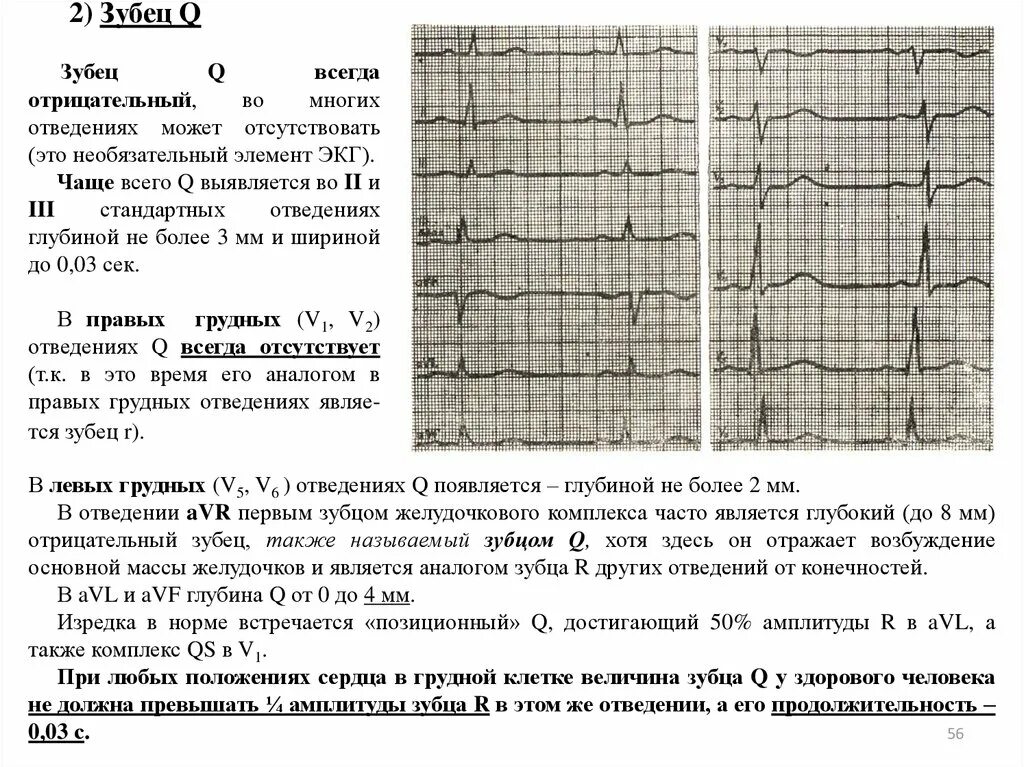 Изменение зубца q. Отрицательный зубец т на ЭКГ В отведениях v1-3. Зубец q II III AVF. Зубец q в 3 отведении и AVF В норме. Отрицательный зубец т в v2-v6.