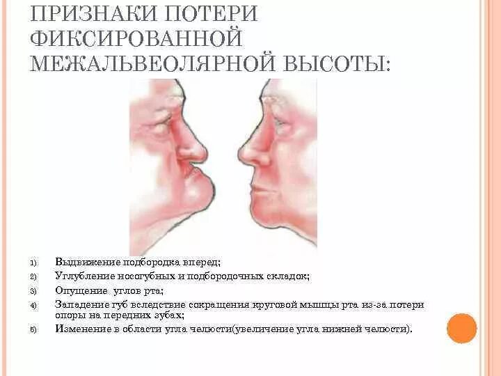 Признаки потери межальвеолярной высоты. Изменение нижней трети лица. Западение верхней губы. Потеря фиксированной межальвеолярной высоты. Опущение угла рта