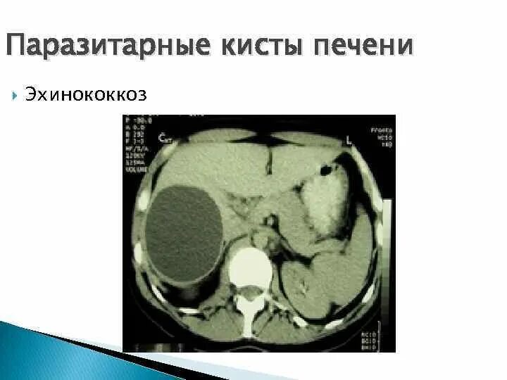 Простая киста печени. Эхинококковая киста брюшной полости кт. Паразитарные кисты печени кт. Эхинококковая киста печени кт. Кисты печени кт эхинококкоз.