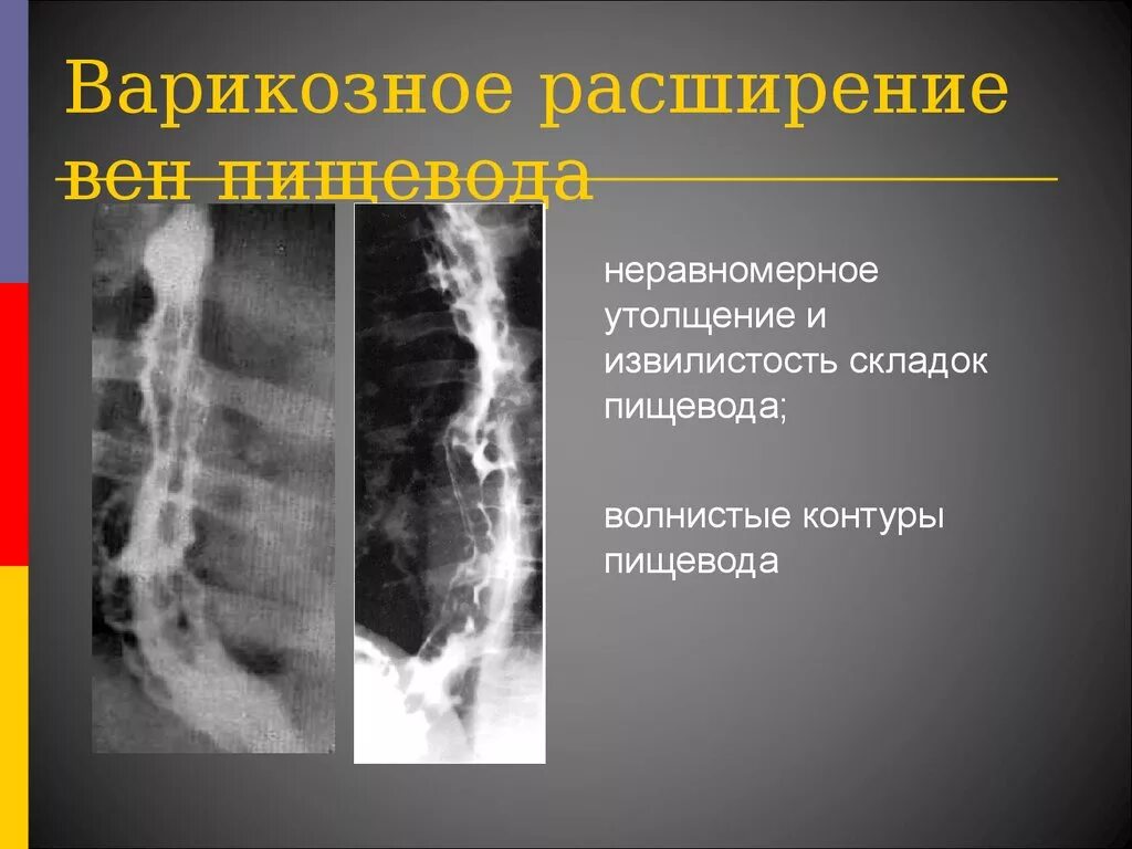 Степени расширения пищевода. Варикозное расширение вен пищевода рентген. Расширение вен пищевода рентгенограмма. ВРВП -варикозное расширение вен пищевода. Расширение вен пищевода рентген.