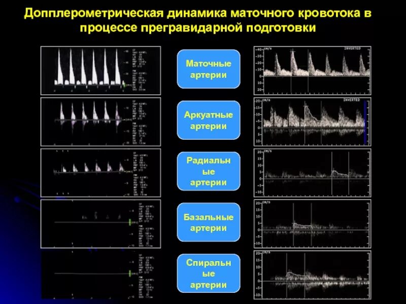 Допплер узи при беременности нормы. Что значит кровоток в матке. Протокол допплерометрии сосудов матки. Кроанток в матосных артеричх. Что значит кровоток в матке.