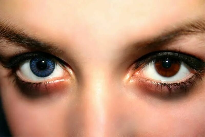 Один глаз серый другой. Центральная гетерохромия карих глаз. Центральная гетерохромия зрачок. Центральная гетерохромия зеленый Карий. Центральная гетерохромия хамелеон.