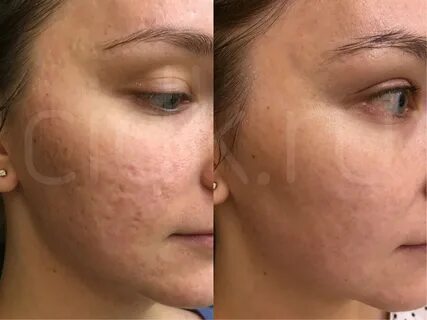 Лазерная шлифовка кожи skinlift