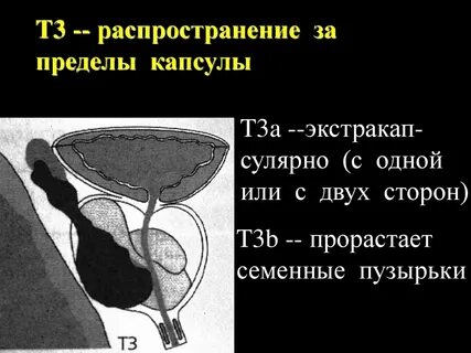 Простаты воронеж
