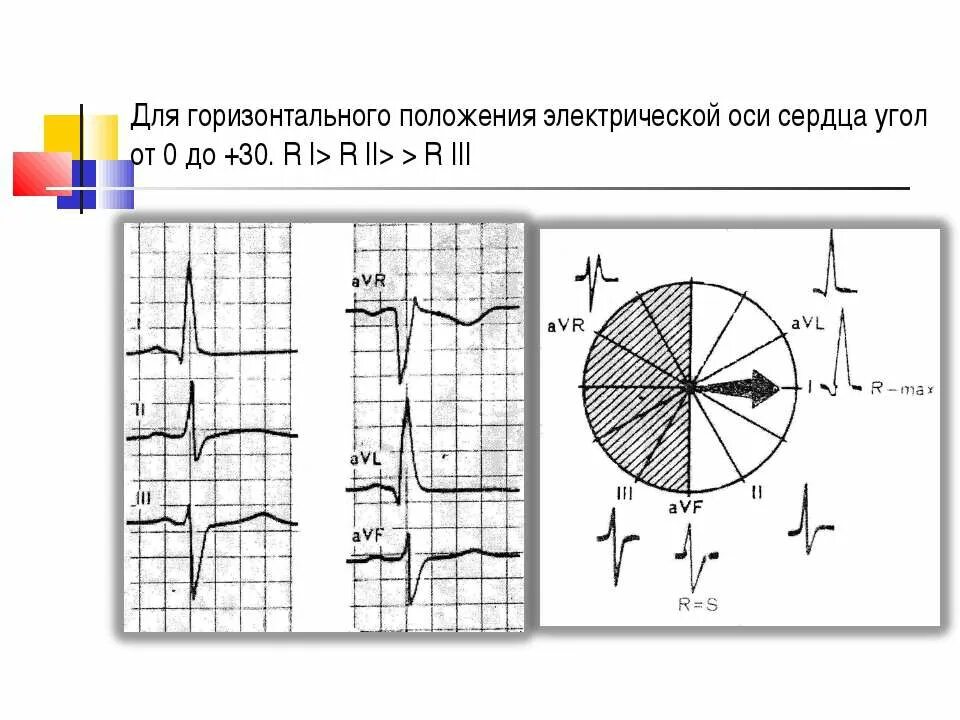 Горизонтальное положение это как. ЭОС горизонтальная на ЭКГ. Горизонтальное положение ЭОС на ЭКГ. Горизонтальная электрическая ось сердца на ЭКГ. Вертикальная ось на ЭКГ.