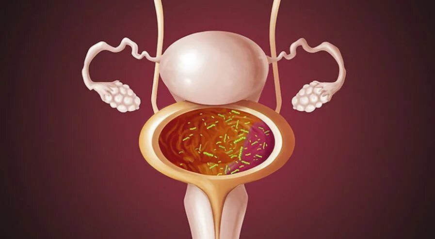 Болезнь мочевого пузыря у женщин лечение. Интерстициальный цистит. Воспаление мочевого пузыря. Инфицирование мочевого пузыря.