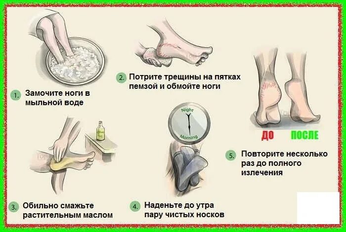 Трещина при беременности. Трещина на пятке народные средства. Трещины на пятках народные средства.