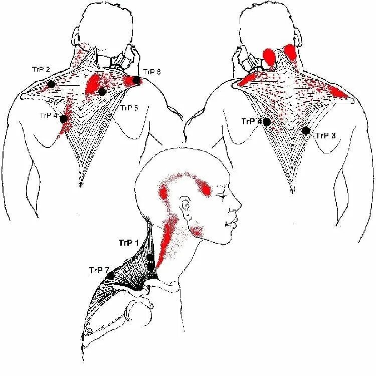 Болит плечо отдает в голову. Миофасциальный синдром триггерные точки. Миофасциальный синдром триггерные точки спины. Триггерные точки шейного отдела. Тт1 триггерная точка.