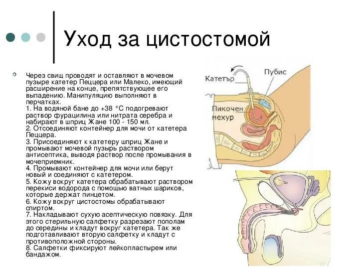 Промывание цистостомы алгоритм. Промывание катетера мочевого пузыря алгоритм. Операция постановки цистостомы. Эпицистостома промывание мочевого пузыря. Промывают мочевой пузырь у мужчин