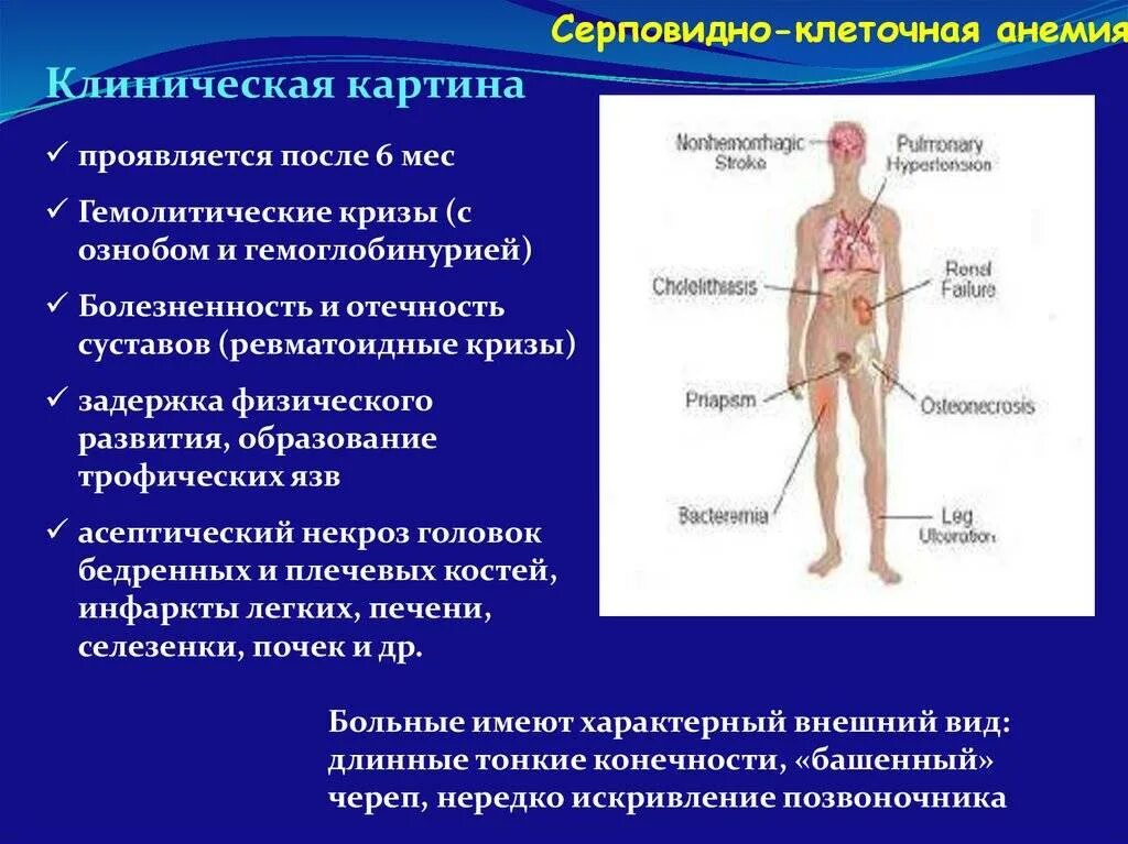 Клинические признаки серповидноклеточной анемии. Серповидно клеточная анемия клиника. Серповидная клеточная анемия симптомы. Серпаыидно кдеточная анемия. Серповидно клеточная анемия признаки