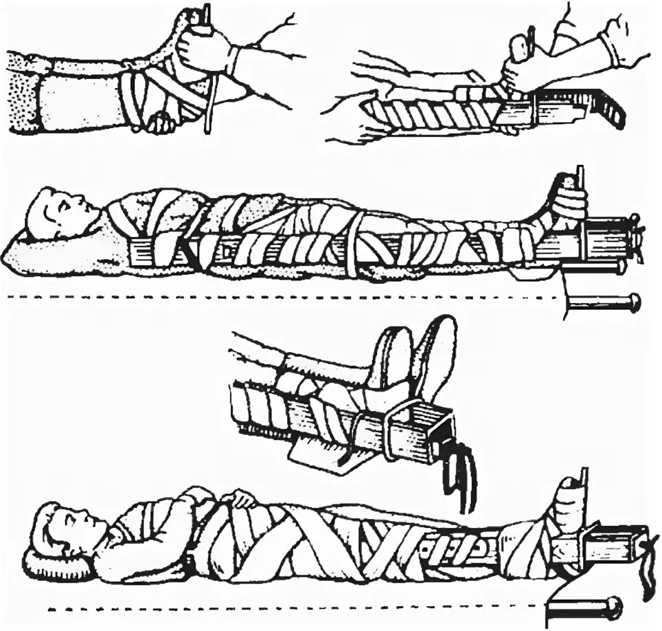 Перелом голени транспортировка. Техника транспортной иммобилизации при переломе костей голени. Перелом бедра иммобилизация. Техника транспортной иммобилизации при переломе бедра. Перелом бедра транспортная иммобилизация.
