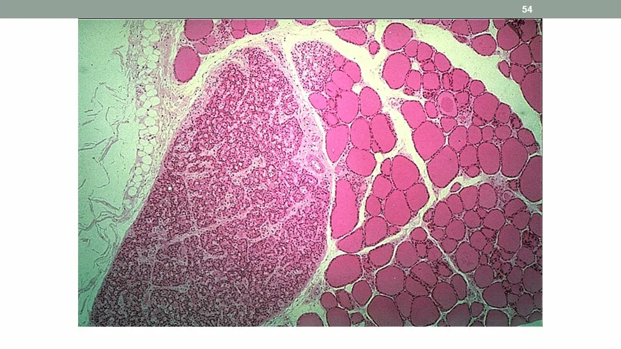 Паращитовидная железа гистология препарат. Околощитовидная железа гистология препарат. Щитовидная железа микропрепарат гистология. Строение околощитовидной железы гистология.