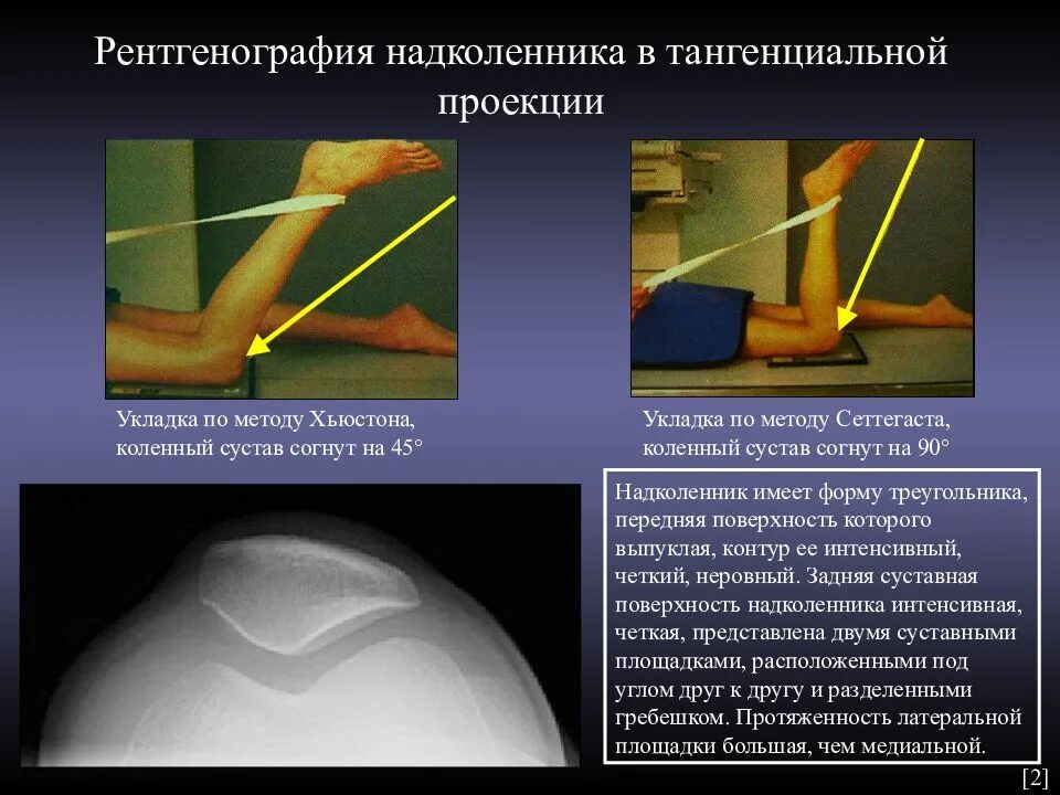 Рентген надколенника