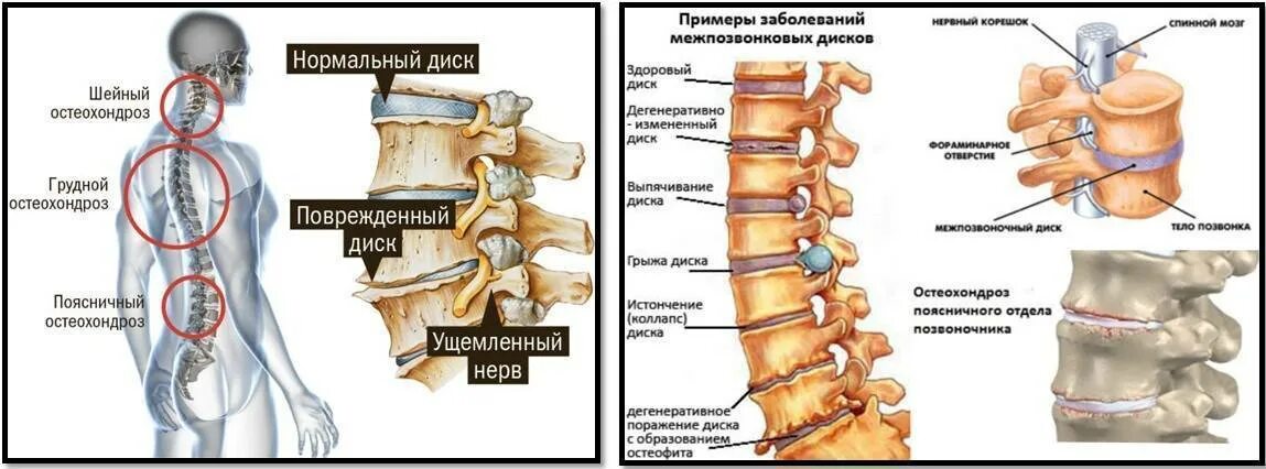 Протрузия грудных позвонков. Дорзальная протрузия th7/8 диска. Протрузии грудного отдела позвоночника мрт. Остеохондроз грудного отдела позвоночника стадии. Протрузии грудного отдела позвоночника мрт.