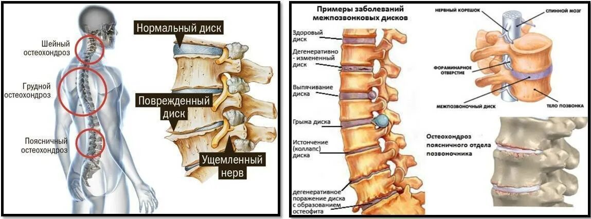 Остеохондроз шейного отдела протрузии. Остеохондроз шейного отдела грыжа межпозвоночного диска. Остеохондроз протрузия грыжа. Остеохондроз, протрузия, грыжа межпозвоночного диска. Остеохондроз грыжа шейного отдела.