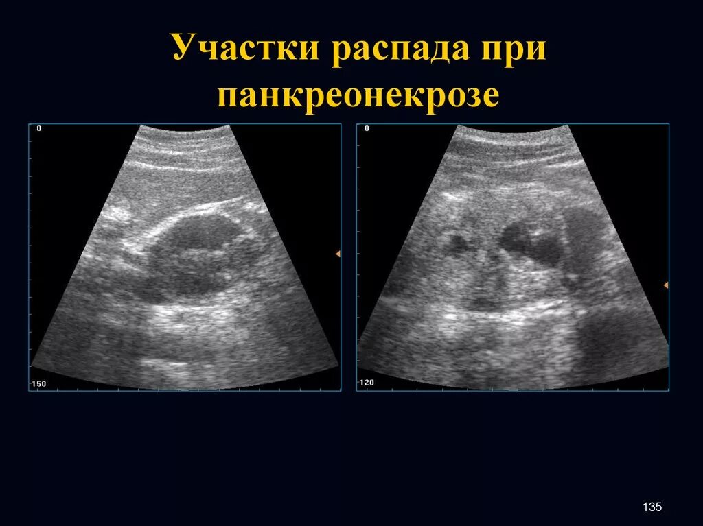 Участок распада. УЗИ признаки панкреонекроза. Панкреонекроз поджелудочной железы на УЗИ. Некроз поджелудочной на УЗИ. УЗИ при панкреонекрозе.