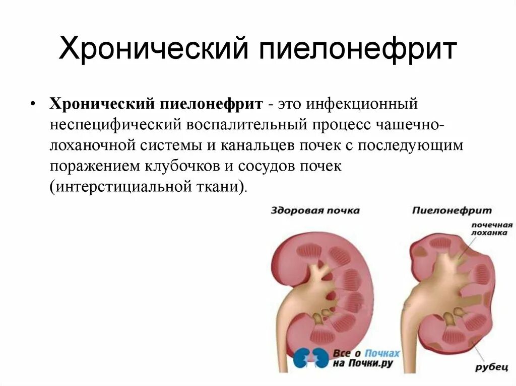 Белки при пиелонефрите. Хронический пиелонефрит. Острый и хронический пиелонефрит. Причины хронического пиелонефрита.