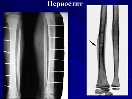 Отек большеберцовой кости