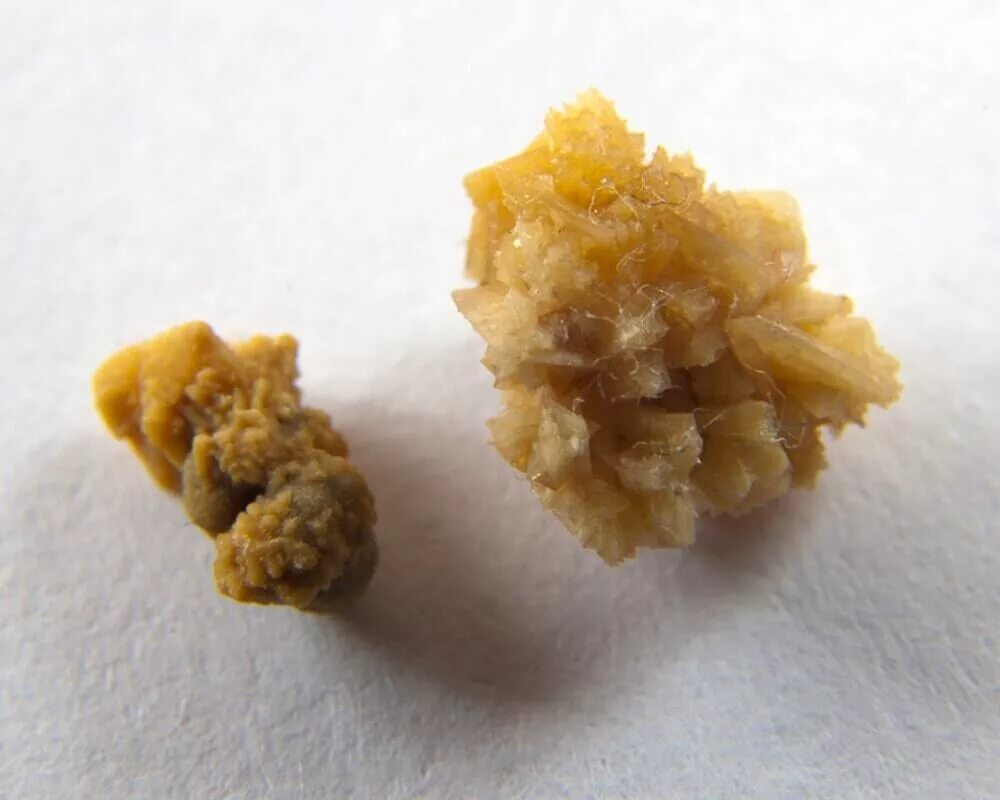 Конкременты что это. Мелкие конкременты в почках на узи. Конкременты желчного пузыря что это такое. Конкременты желчного пузыря узи. Конкремент лоханки узи.