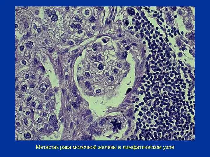 Лучевая терапия метастазов в лимфоузлах. Лучевая терапия метастазов в лимфоузлах