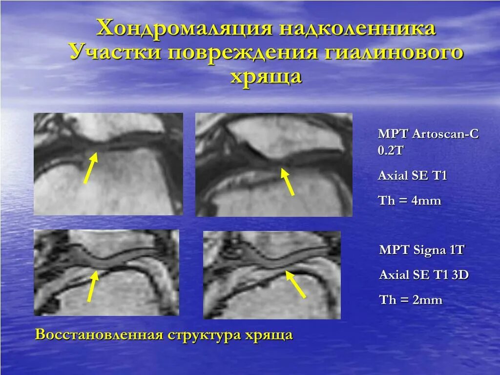 Хондромаляция 1 степени