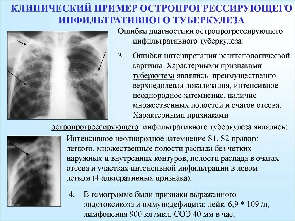 Внутренний туберкулез