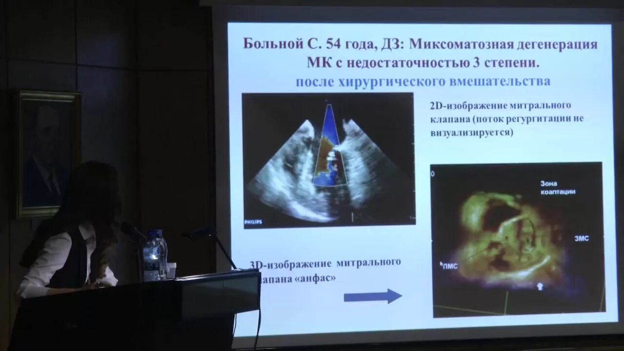 Миксоматозная дегенерация. Джанкетова Марзият Султановна. Джанкетова Марзият Султановна терапевт биография.