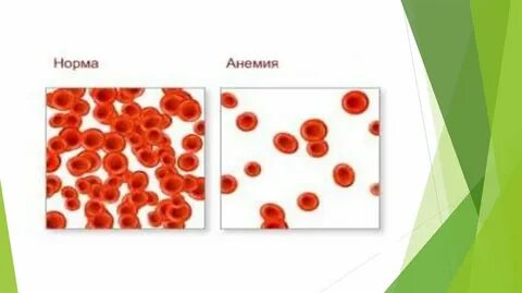 Анемия авитаминоз