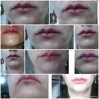 Как заживают губы после увеличения