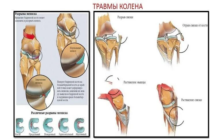 Разрыв поперечной связки мениска. Разрыв мениска коленного сустава схема. Повреждение связок коленного сустава классификация. Перерастяжение связок коленного сустава.