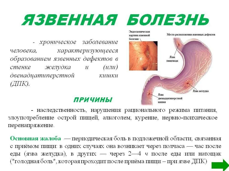 Гастрит 2 стадии. Язвенная болезнь желудка и 12 перстной. Обострение язвенной болезни желудка и 12-перстной кишки.. Жалобы при язвенной болезни желудка и 12-перстной кишки. Причины заболевания язвенной болезни желудка.