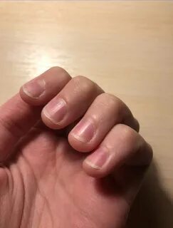 Плоские ногти на пальцах рук