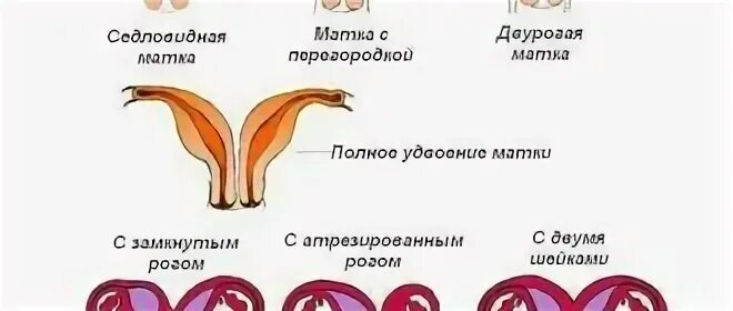 Полное удвоение матки и шейки. Отличие рожавшей и нерожавшей. Отличие рожавшей и нерожавшей женщины.