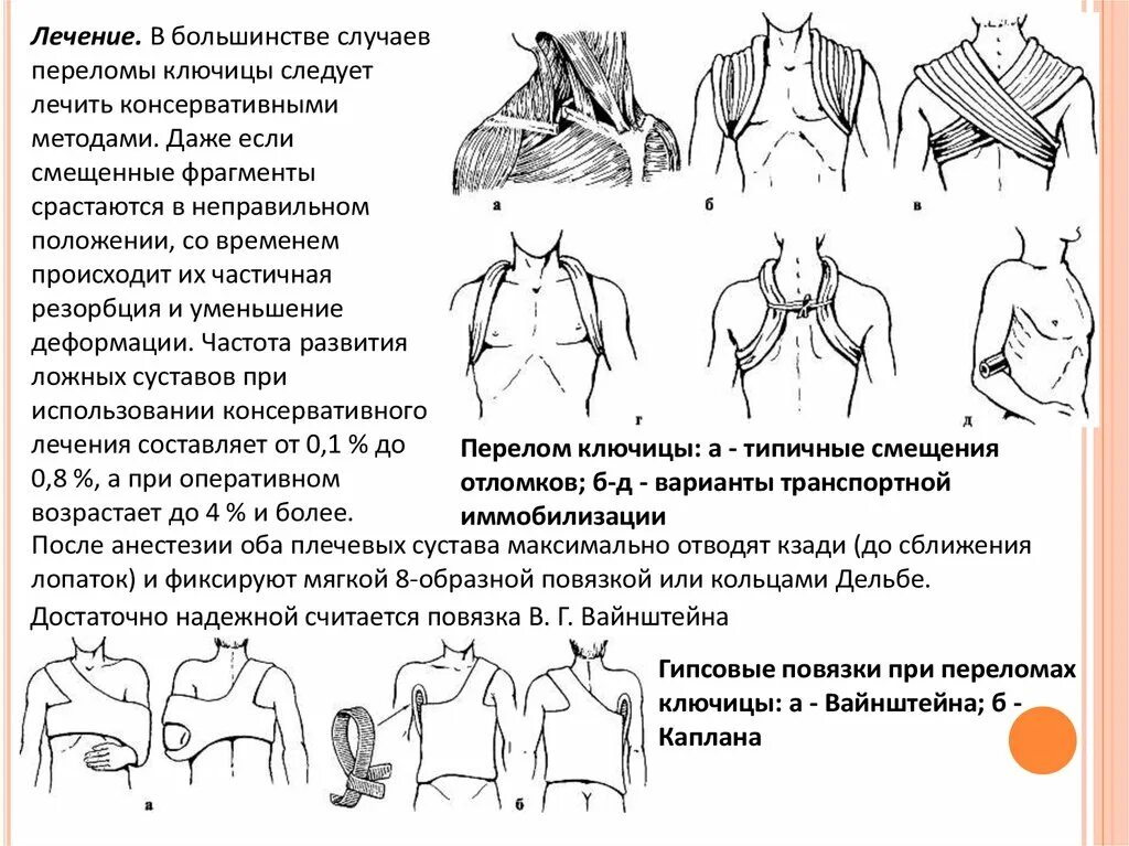 перелом ключицы новорожденного клинические рекомендации. рентгенограмма новорожденного. порядок наложения повязки дезо. перелом ключицы повязка дезо кольца дельбе. периимплантный перелом ключицы.