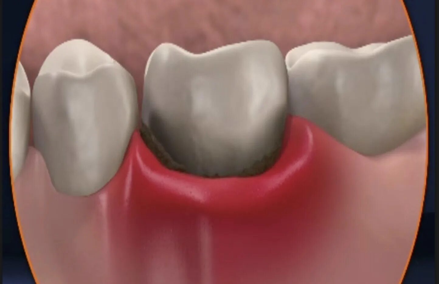 межкорневой периодонтит. кариес пульпит периодонтит. периодонтит корня зуба. заболевания зубов и дёсен.