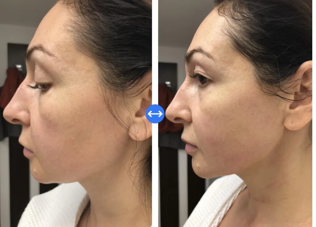 Sculptra полимолочная кислота. AESTHEFILL (Эстефил). Miraline полимолочная кислота. Аэстефил полимолочная кислота.