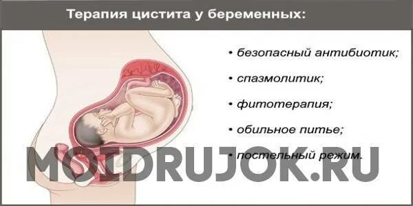 Цистит забеременеть. Цистит у беременных на ранних сроках. Цистит при беременности на ранних сроках. Цистит в 3 триместре беременности. Цистит у беременных симптомы.