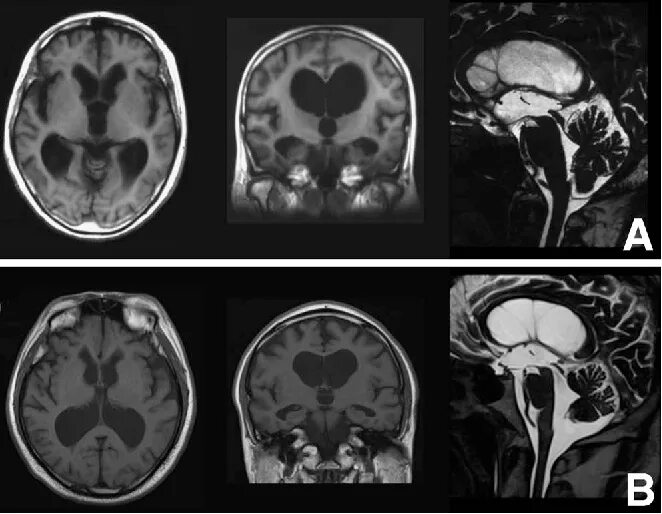 Неокклюзионная гидроцефалия. Hydrocephalus Roona. Normotensive Hydrocephalus MRI.